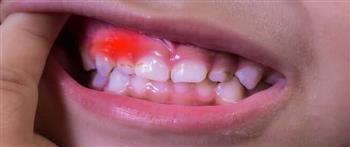   تعرف على أسباب خراج الأسنان عند الأطفال