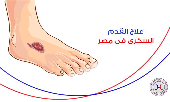 تنظيف الغرغرينا في وجود قصور بالدورة الدموية جريمة بشعة