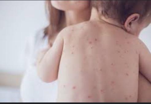 اعرف مرض جدري القرود واعراضه وكيفية علاجه.. بالتفاصيل