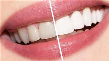   3 طرق طبيعية  لتبييض الأسنان