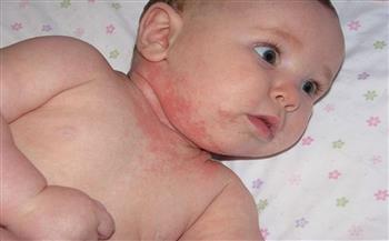أسباب حساسية الجلد عند الأطفال.. تعرّف عليها