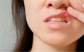   أعراض نقص فيتامين ب 12.. علامة تظهر عند فتح الفم