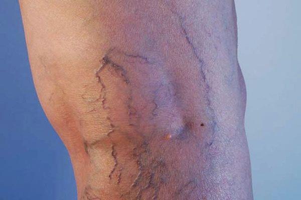 دراسة تشير إلى أهمية الخيار الجراحي في الدوالي المرتبطة بعامل وراثي