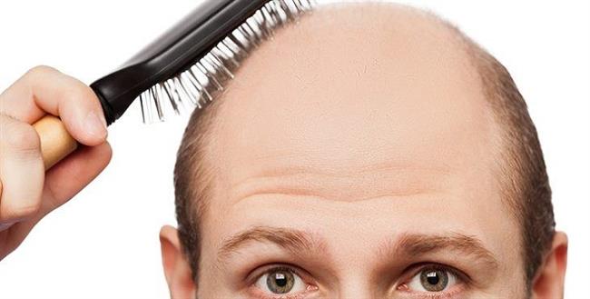 7 أسباب و6 خطوات للعلاج الصلع المبكر