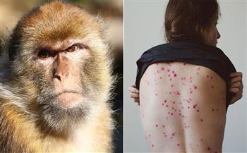   ارتفاع إصابات "جدري القرود" في بريطانيا إلى 225 حالة