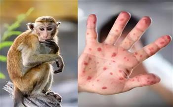    21 إصابة بجدري القرود في الولايات المتحدة
