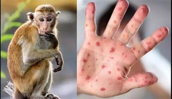   «الصحة العالمية»: تسجيل 780 حالة إصابة بـ«جدري القرود» في 27 دولة