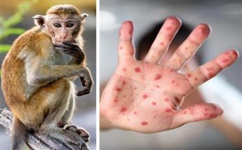   الإعلان عن أول حالة إصابة بفيروس «جدري القردة» فى روسيا