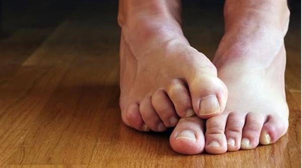 علامتان على أظافر قدميك مؤشر على مرض خطير