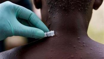   «الصحة العالمية»: تطعيم جدري القرود غير إجباري