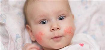   كيفية التعامل مع حساسية البيض عند الأطفال
