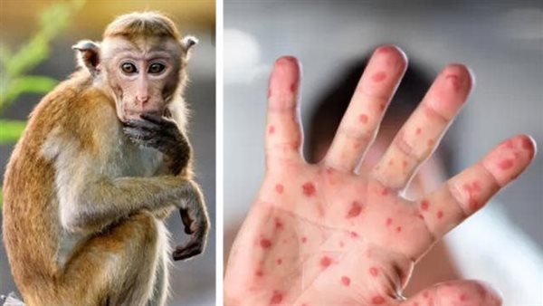 الصحة العالمية تعلن حالة طوارئ بعد تفشى «جدري القرود» .. واستشاري مناعة يكشف التفاصيل