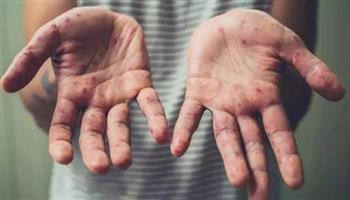 جدري القرود يثير قلق العالم من جديد