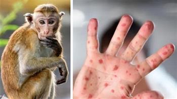   الصحة العالمية تعلن حالة طوارئ بعد تفشى «جدري القرود» .. واستشاري مناعة يكشف التفاصيل