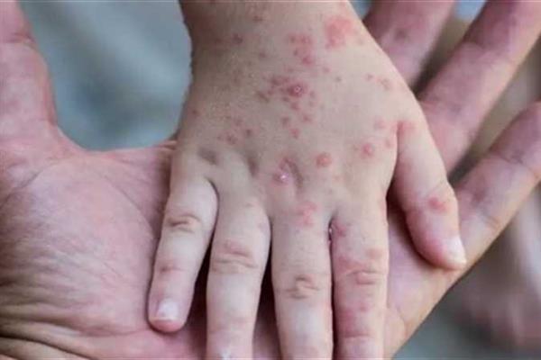 أستاذ مناعة يوضح وسائل انتقال جدري القرود.. فيديو