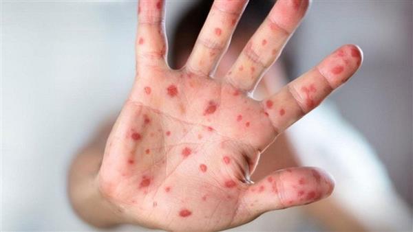 ولاية نيويورك تعلن جدري القردة تهديدًا للصحة العامة