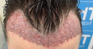 هل زراعة الشعر حرام ؟.. الإفتاء تجيب