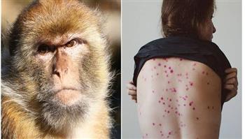   دراسة: أعراض مختلفة لجدري القرود ومخاوف من عدم التعرف على بعضها