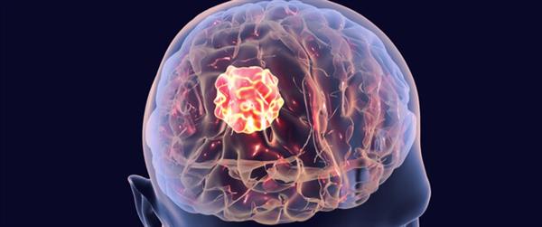 استشارى جراحة مخ وأعصاب: 30% من أورام المخ خبيثة و2% من مرضى الصداع يشخصون بأورام مخية