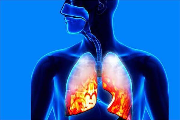 ابتكار مركبات كيميائية جديدة لعلاج التهاب الرئتين الحاد