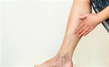   أعراض جلطة الساق وأسبابها وعلاجها والوقاية منها