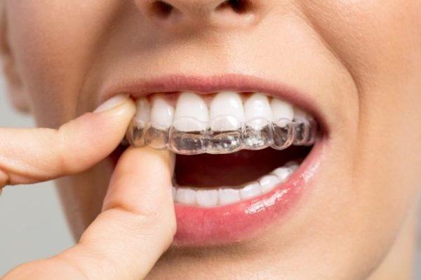 "الإفتاء" تكشف حكم تقويم الأسنان