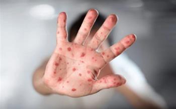   الفلبين تسجل رابع حالة إصابة بفيروس «جدري القردة»