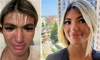 بسبب أشعة الشمس.. امرأة تتحول بشرتها إلى بلاستيك!