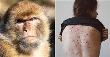   «الصحة العالمية»: 35 إصابة بجدري القردة بإقليم شرق المتوسط
