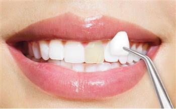   «نهى عمارة»: تركيب فينير الأسنان للمعالجة والتجميل