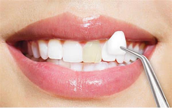 «نهى عمارة»: تركيب فينير الأسنان للمعالجة والتجميل