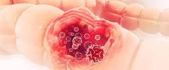 دراسة طبية: ٢٧٪ احتمالية الاصابة بسرطان القولون بسبب النظام الغذائي