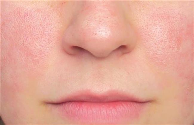 طرق طبيعية لعلاج مسامات الأنف الواسعة