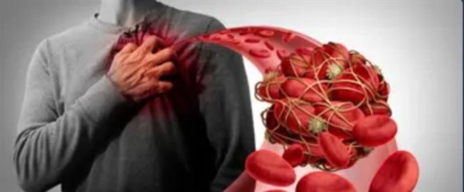 إحذر الإصابة بجلطة مفاجئة 