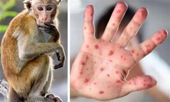   البحرين تسجل أول حالة إصابة بجدري القردة لوافد من الخارج