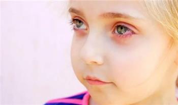   فقدان البصر .. روشتة طبية للتعامل مع حساسية والتهابات عيون الأطفال