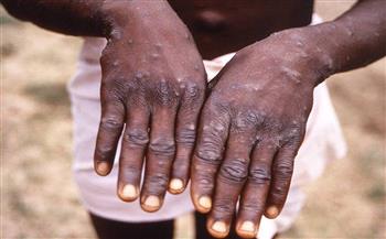   الصحة السودانية تعلن تسجيل 5 حالات جديدة بفيروس جدرى القرود