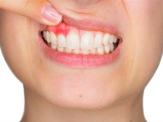 دراسة تفيد بتطوير "هلام" لعلاج أمراض اللثة من خلال محاربة الالتهابات
