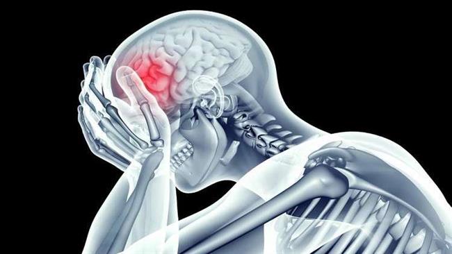 خبير صحي.. الاجهاد يؤدي إلى سكتة دماغية 