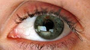  دراسة حديثة تربط تراجع البصر بالتوتر