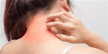 الأعشاب أقوى علاج مضاد للهيستامين