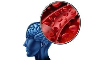 أبرز 7 أعراض لتمدد الأوعية الدموية في الدماغ