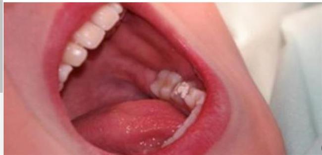 أعراض ضرس العقل المدفون وعلاجه