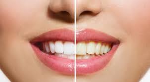   وصفات طبيعية لتبييض الأسنان أفضل من معجون الأسنان