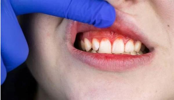 أسباب حساسية الأسنان وعلاجها