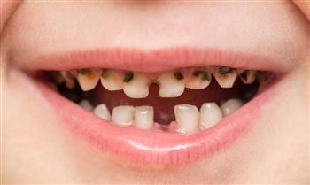   أخصائي طب الأطفال: هناك 6 خطوات بسيطة لتفادي تسوس أسنان الأطفال 