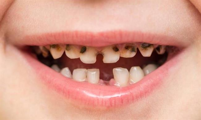 أخصائي طب الأطفال: هناك 6 خطوات بسيطة لتفادي تسوس أسنان الأطفال 