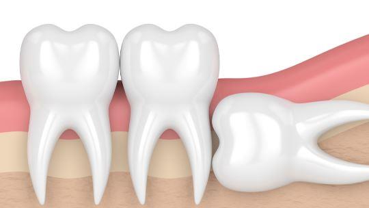 أعراض ومضاعفات ضرس العقل المدفون 