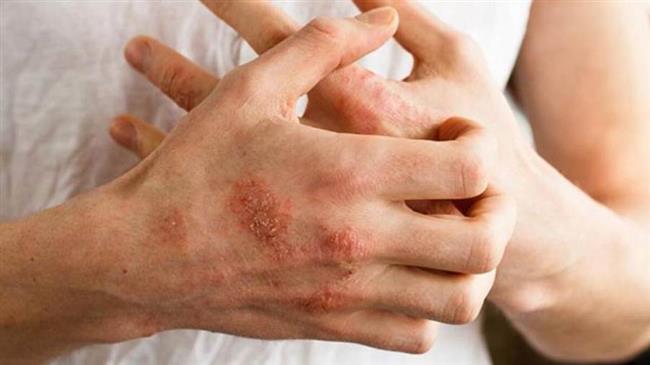دراسة: "الأكزيما" مرتبطة بزيادة مشاكل الصحة العقلية