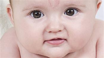   بقعة السلمون شائعة لدى حديث الولادة.. اعرف التفاصيل 